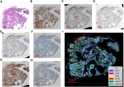 Quantifying spatial CXCL9 distribution with image analysis predicts improved prognosis of triple-negative breast cancer
